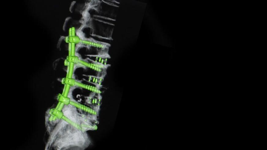 spinal cord implant