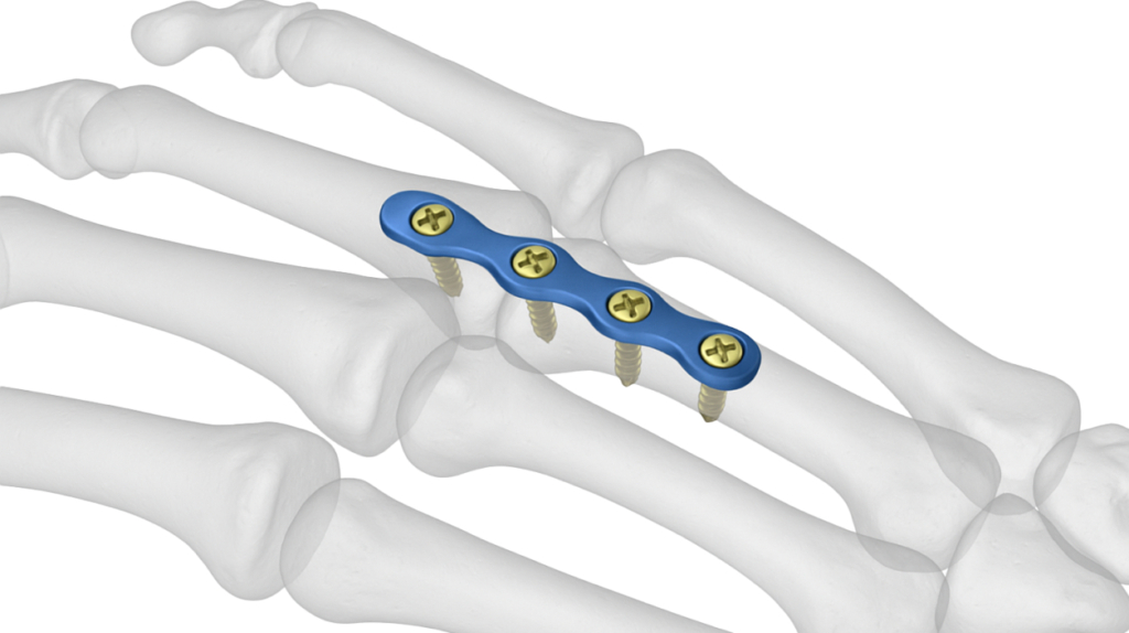 Hand bones with blue orthopedic plate and screws, demonstrating miniaturized surgical implant.